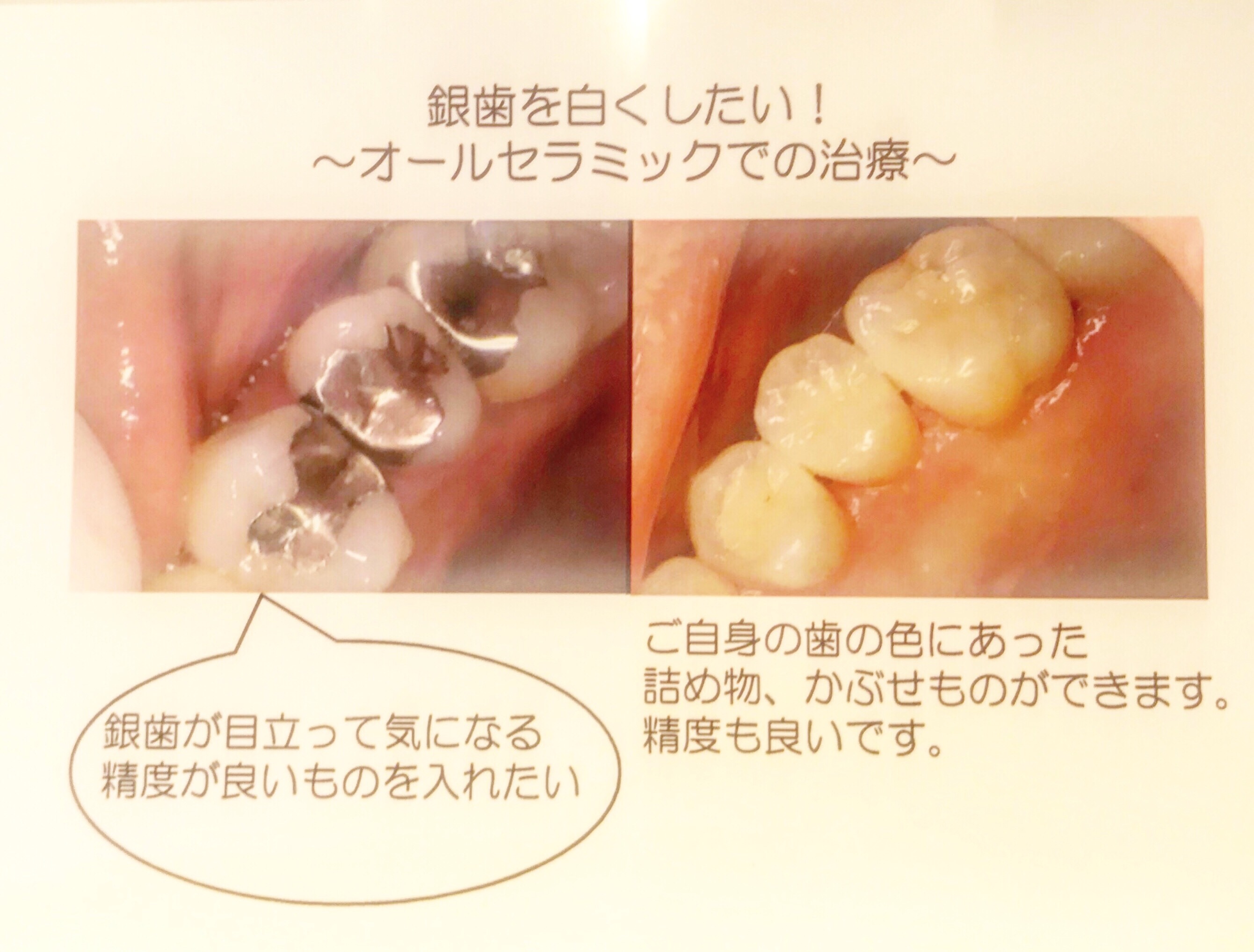 銀歯を白くしたい！オールセラミックでの治療