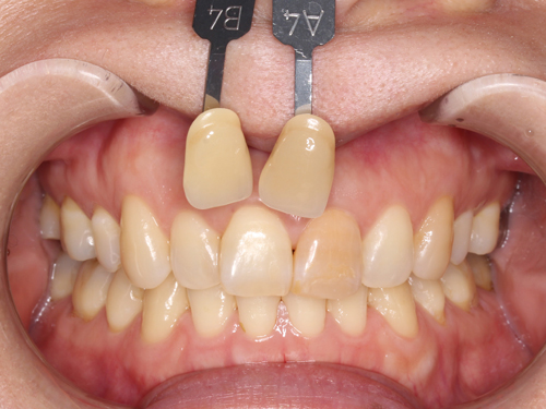 失活歯のホワイトニング症例 Before