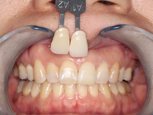 失活歯のホワイトニング症例 After